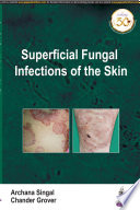 Archana Singal, Chander Grover — Superficial Fungal Infections of the Skin